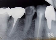 虫歯、歯槽膿漏